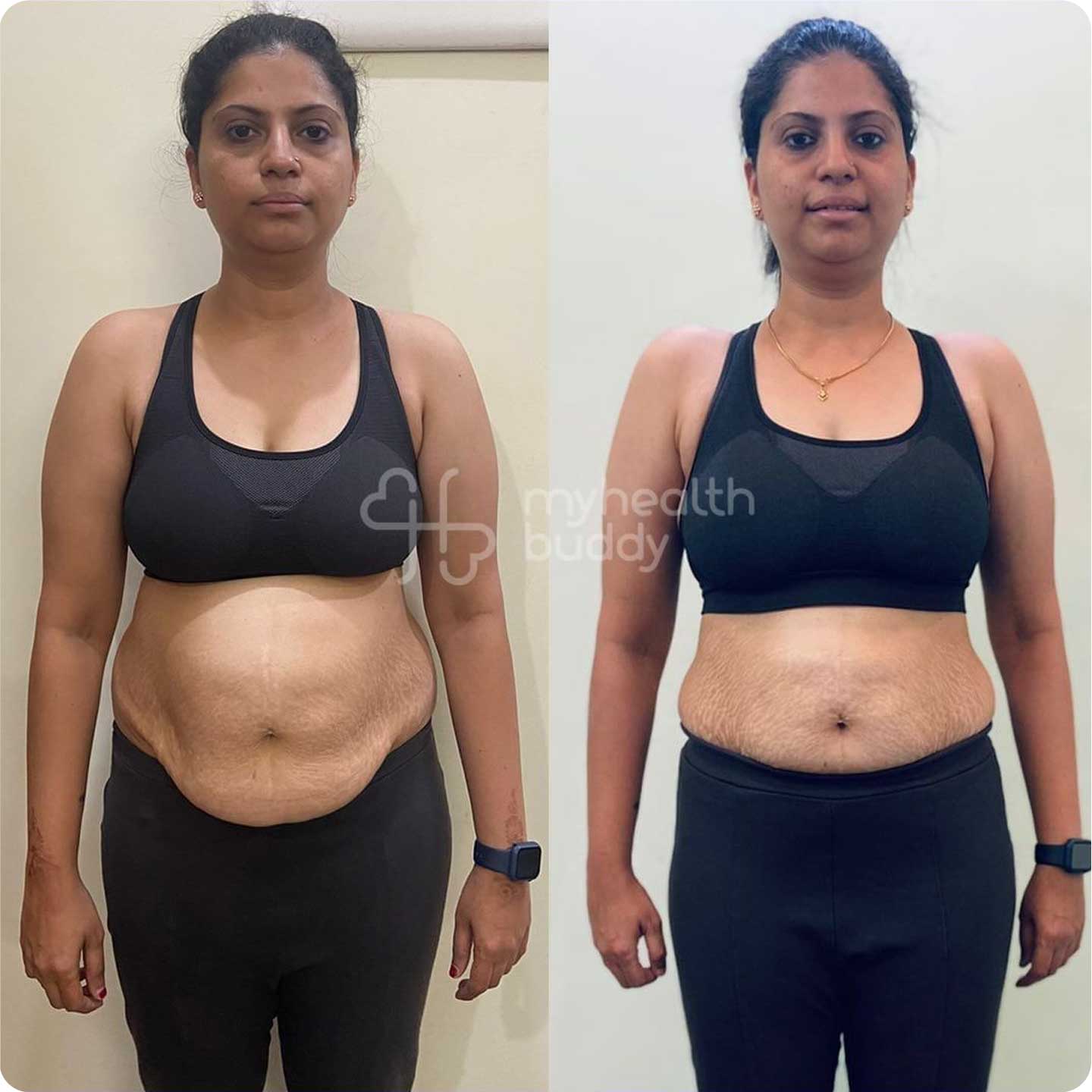 Fat Belly Before And After Fat Belly Before And After